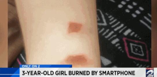 美国一女孩胳膊被LG手机烧伤：看起来很严重